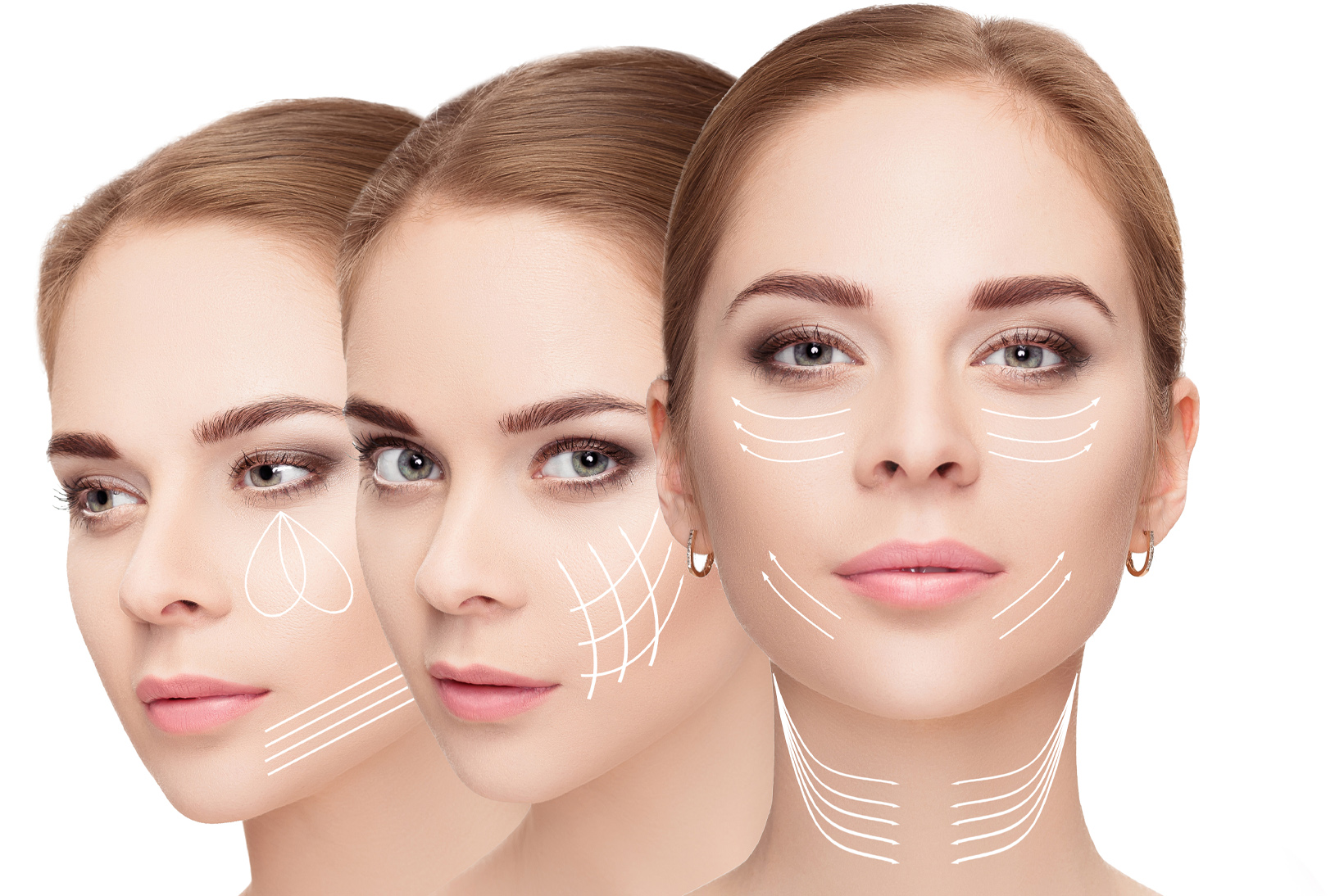 Biostimolazione senza aghi PRX T-33